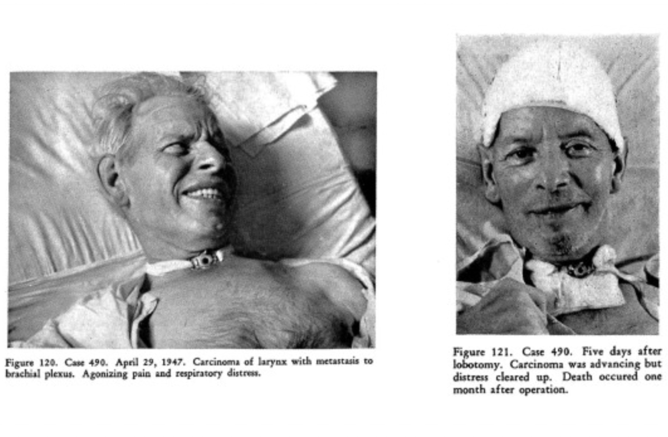 lobotomy psychosurgery - Figure 120. Case 490. . Carcinoma of larynx with metastasis to brachial plexus. Agonizing pain and respiratory distress. Figure 121. Case 490. Five days after lobotomy. Carcinoma was advancing but distress cleared up. Death occure